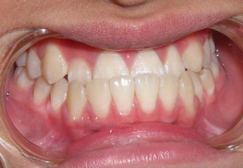 Niềng răng móm có phải nhổ răng không